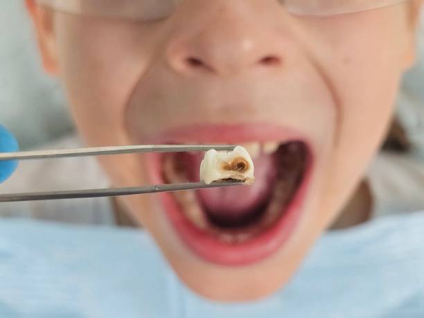 Best Walk-In Emergency Dentist in Kennesaw State University, GA