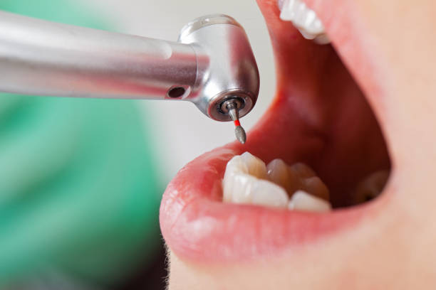 Best Emergency Root Canal Treatment in Kennesaw State University, GA